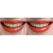 Professional 35% Teeth Whitening Gel - 2 Large 20ml Syringes | Instant White Smiles - Buy Online on GoSupps.com
