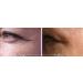 True Radiance Lineless Eye Cream - Reduces Crows Feet, Dark Circles & Puffiness - Anti-Wrinkle Formula with Reguage, Syncoll, Pepha-tight & Dmae - Paraben-Free - 1/2 Oz - Buy Online on GoSupps.com