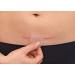 Hansaplast Scar Reduction Plasters - 21 XL Pieces (3 cm x 14.6 cm) for Visible Scar Healing | Soft & Flat Scars - Buy Online on GoSupps.com