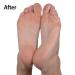 Emjoi Micro-Pedi Nano Pro Callus Remover - Smooth, Soft Feet in Seconds - Buy Online on GoSupps.com