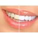 35% Teeth Whitening Kit with Tooth Gel and Trays - Bright White Smiles - Made in the USA - Buy Online on GoSupps.com