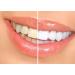 Professional 44% Carbamide Peroxide Teeth Whitening Kit with Gel, Trays, and LED Light - Buy Online on GoSupps.com