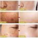 (Must - Have) Super Luxe Skin Re_mover Super Luxe Skin Re_moval Skin Tag Re_mover Cream Painless Mole and Skin Re_mover for All Skin Types (2PC) - Buy Online on GoSupps.com