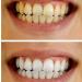 Nite White Excel 3 ACP Z 16% Teeth Whitening 9pk Kit - Latest Product - Buy Online on GoSupps.com