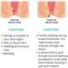 EXQST Heca Natural Herbal Hemorrhoid Capsules - Fast Relief (7 Capsules/Box) - Buy Online on GoSupps.com