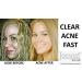Sulfur Soap for Acne 100G - Pharmaceutical Grade, Dermatologists Approved, FDA Certified for Acne Rosacea - Buy Online on GoSupps.com