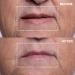 Wrinkles Schminkles Eye & Mouth Lift Set | Reusable Silicone Patches for Mouth & Lip Wrinkles (2-Pack) & Eye Wrinkles (3-Pairs) - Shop Internationally - Buy Online on GoSupps.com