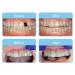OrVance Aligner Pontics | 32 Count Clear Aligner Tray Fillers for Missing Teeth - Buy Online on GoSupps.com