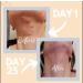 Anirva ClearDerm: Zinc Skin Supplement for Hormonal Acne & Rosacea - Adult Acne Zinc Pills - Buy Online on GoSupps.com