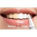 WHITELY Wireless Teeth Whitening Kit with Aloe Leaf Extract - Professional Whitening Agent - Buy Online on GoSupps.com