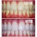 Bright White Smiles 44% Carbamide Peroxide Teeth Whitening Gel Refill Kit - 10 Tubes - Buy Online on GoSupps.com