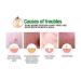 [Acropass] Trouble Cure Plus - Instant Acne Pimple Patch with Hyaluronic Acid Micro Structure - Buy Online on GoSupps.com
