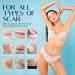 Silicone Scar Sheets 4 Pack for Surgery Scars Treatment - 5.7x1.57 Inch Tape Strips for Keloid, C-Section, Tummy Tuck, Stretch Marks - Surgical Scar Healing Cream Gel Patch Pad - Buy Online on GoSupps.com