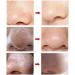 FEDRUI Blackhead Remover Pore Cleaner Blackheads Pore Sucker with 5 Suction Heads Acne Comedone Extractor Kit Blackhead Removal Tool for Beauty Salon (Color : White) - Buy Online on GoSupps.com