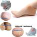 Silicone Gel Heel Protector for Plantar Fasciitis - Moisturizing Socks for Hard Cracked Dry Skin - One Pair by Alayna - Buy Online on GoSupps.com