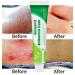 Herbal Anti-Itch Eczema Relief Ointment for Skin Rash Treatment - Buy Online on GoSupps.com