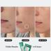 Geologie Blemish Buster Kit - Fast-Acting Hydrocolloid Acne Patches & Spot Treatment for Redness Reduction & Scar Prevention | Clear Acne with Geologie - Buy Online on GoSupps.com