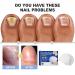 Furzero Purenail Laser Therapy Device | Effective Nail Fungus Treatment & Light Therapy for Healthy Nails - Buy Online on GoSupps.com