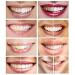 White Teeth Global 44% Carbamide Peroxide Teeth Whitening Gel - 6 Syringes - Buy Online on GoSupps.com