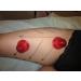 Boolavard 2X Silicone Massage Cupping Anti-Cellulite Cups - Beauty Therapy Essential - Buy Online on GoSupps.com