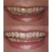ProDental Teeth Whitening Gel Syringe Refill 10 Pack | 35% Carbamide Peroxide | 60 Treatments | Fast Results | Safe for Sensitive Teeth - Buy Online on GoSupps.com