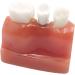 4x Dental Implant Teeth Model with Removable Crown - Crown & Bridge Dentist Training Tool for Patient Analysis | International Shipping - Buy Online on GoSupps.com