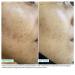 Urban Skin Rx After Breakout Fade + Clarify Serum | Fades Acne Scars & Dark Spots | Vegan & Cruelty-Free Skincare for All Skin Types | 1 Fl Oz - Buy Online on GoSupps.com