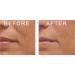 Galia MATRIXYL 3000 Peptide Serum + Hyaluronic Acid For Anti Aging + Anti Wrinkle Serum for Wrinkles Fine Lines Sun Spots Powerful Anti Aging Face Serum 30 ml - Buy Online on GoSupps.com