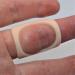 ArthroEze Oval Trigger Finger Splint Peach (Size 10.5 - (63.5mm CIRC))