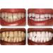 Ultra-White Teeth Whitening Pen 2 Pack - Fast Results Guaranteed for Stained, Discolored, and Yellow Teeth - Buy Online on GoSupps.com