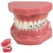Gylejwh dental teeth Orthodontic model with metallic and ceramic brackets orally demonstrates models for the dentist to communicate with patients