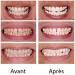 Teeth Whitening Kit Whitens and protects enamel Professional teeth whitening Certified and clinically tested gel ECLAWHITE - Buy Online on GoSupps.com