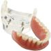 Gljy Dental Restoration Model - Overdenture Inferior 2 Implants Teaching Aid | Detachable Dental Teeth Model for Precision Demo | International Shipping Available - Buy Online on GoSupps.com