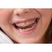 Smiley Face Snapcaps - Orthodontic Braces Wax Alternative (10 Ct.) - Buy Online on GoSupps.com