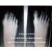 Bunion Corrector for Men & Women - Orthopedic Bunion Relief Toe Socks & Splint - X-Small Left & Right - Buy Online on GoSupps.com