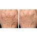 Effective Skin Care Solutions: Cure Acne Psoriasis Sunspots & Scars Shop Internationally - Buy Online on GoSupps.com