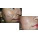 Sodermix 30g: Effective Treatment for Psoriasis and Eczema Scars - Buy Online on GoSupps.com