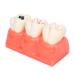 Verdant touch simulation teeth caries model tooth caries model tooth caries demonstration model with removable teeth simulation tooth caries model