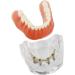 Dental Restore Model with 4 implants implant Demonstration Lower Precision Model Dental Teeth Restoration semi-Covered Prosthesis Decoration - Buy Online on GoSupps.com