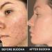 Buy Chemical-Free Acne Ubtan (50g) - Exfoliate Pimples & Rough Skin with Premium Clays | International Shipping - Buy Online on GoSupps.com
