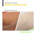 Tea Tree Spot Patch 90 Dots with Salicylic Acid for Acne Blemishes - Invisible Bandaids for Covering Pimples - Face Stickers for Blemish Control - 0.55 Inch Patches - Buy Online on GoSupps.com
