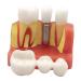 Dental implant analysis crown bridge model 4 times dental implant teeth model with removable crown dentists patient implant teeth model red