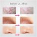 Rose Gold Acne Needle Kit - 8PC Blackhead Remover & Pore Cleanser Tools for Perfect Skin - Buy Online on GoSupps.com