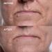 Wrinkles Schminkles Mouth & Lip Wrinkle Patch 2-Pack - Silicone Smoothing Pads for Lip Wrinkle Prevention - Hypoallergenic & Reusable - 1 Pair - Buy Online on GoSupps.com