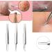 1Pc Professional Stainless Bend Curved Tweezer Blackhead Acne Clip Comedone Pimple Extractor Remover Tool for Comedone Whitehead Acne Blemish Bend ClipSimple and Sophisticated Design - Buy Online on GoSupps.com