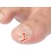 BEALIFE Curved Toenail Corrector Strips for Ingrown Toenails Effective Foot Care Solution - Buy Online on GoSupps.com