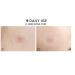Buy Acne Pimple Patch (24 Patches) - Invisible Hydrocolloid Healing Patches for Zit & Pimple Care | Waterproof & Absorbs Pus | Fast Shipping Worldwide - Buy Online on GoSupps.com