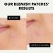 Hydrocolloid Acne Patches - 72 Count | Blemish & Zit Cover | Day & Night Acne Treatment | Invisible Pimple Patch by Eclat - Buy Online on GoSupps.com