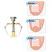 Ingrown Toenail Corrector & Lifter - Professional Toe Clamp for Effective Treatment - Buy Online on GoSupps.com