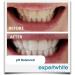 QuickGlo Rapid 35% Carbamide Peroxide Teeth Whitening Gel - Dentist Grade Refill Syringes (4x3cc) for Fast White Teeth - Made in USA - Buy Online on GoSupps.com